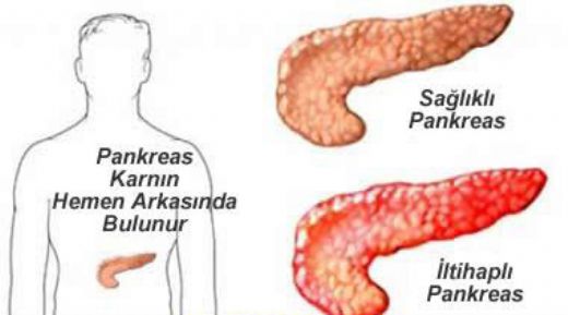 Pankreas Hastalklar