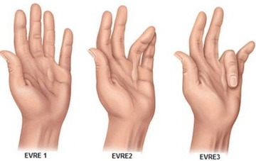 Doku Hastalıkları Belirtileri ve Tedavisi