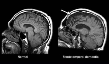 Pick Hastalığı Belirtileri ve Tedavisi