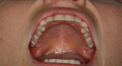 Ağız Hastalıkları Belirtileri ve Tedavisi