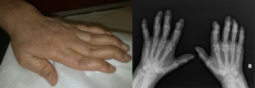 Akdeniz Hastalığı Belirtileri ve Tedavisi