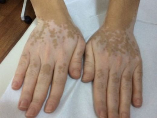 Ala Hastalığı Belirtileri ve Tedavisi