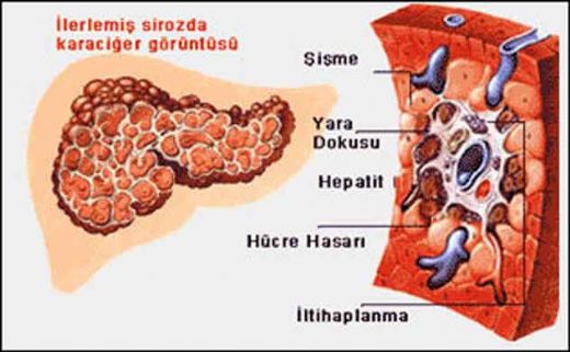 Alkol Hastalıkları Belirtileri ve Tedavisi