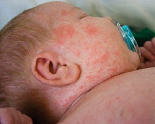 Altıncı Hastalık Belirtileri ve Tedavisi