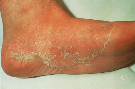 Ayakta Sedef Hastalığı Belirtileri ve Tedavisi