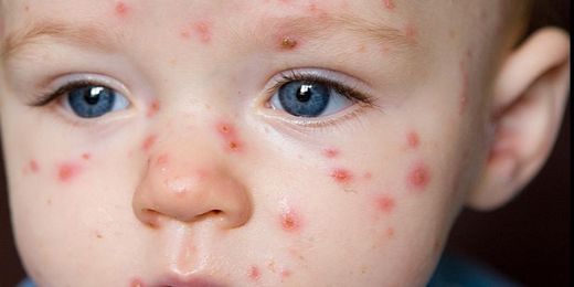 Bebeklerde 5 Hastalık Belirtileri ve Tedavisi