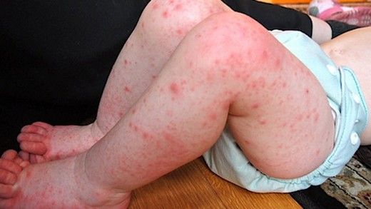 Bebeklerde El Ayak Ağız Hastalığı Nelerdir?