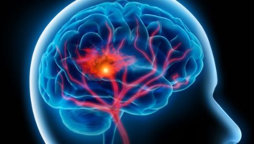 Beyin Hastalıkları Belirtileri ve Tedavisi