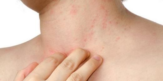 Cilt Hastalıkları Kaşıntı Belirtileri ve Tedavisi