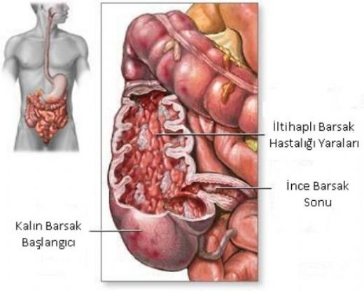 Crohn Hastal