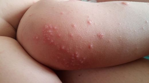 El Ayak Hastalığı Belirtileri ve Tedavisi