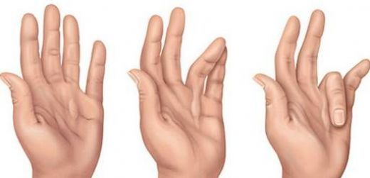 El Hastalıkları Nelerdir?