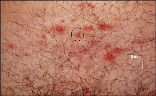 Genital Hastalıklar Belirtileri ve Tedavisi