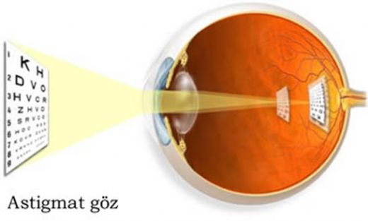 Göz Hastalıkları Astigmat Belirtileri ve Tedavisi
