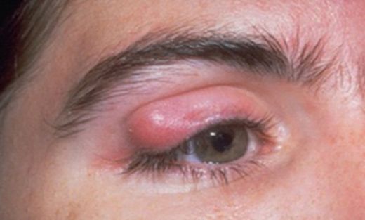 Göz Hastalıkları Çeşitleri Nelerdir?