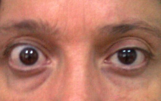 Göz Kapağı Hastalıkları