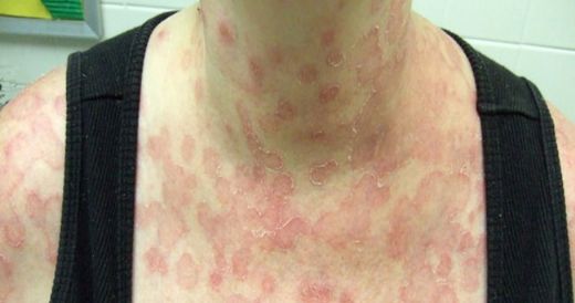 Gül Hastalığı Belirtileri ve Tedavisi