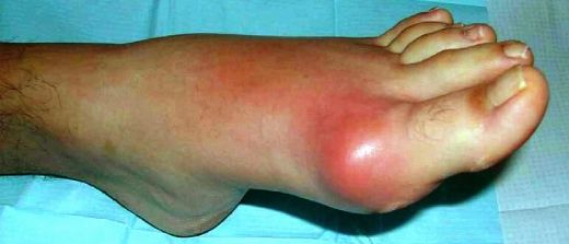 Gut Hastalığı Belirtileri ve Tedavisi