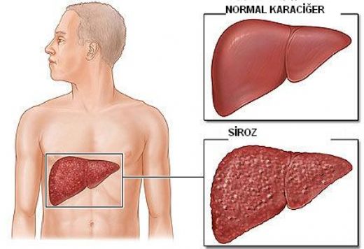 Hepatit Hastal