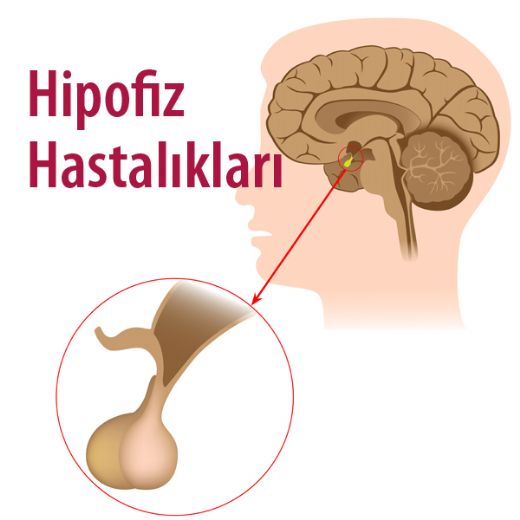 Hipofiz Bezi Hastalıkları Belirtileri ve Tedavisi