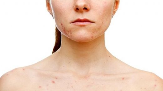 Hiv Hastalığı Belirtileri ve Tedavisi