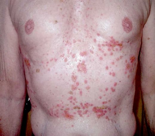 İtp Hastalığı Belirtileri ve Tedavisi