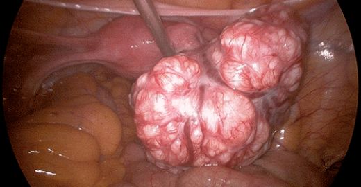 Kadın Hastalıkları Ameliyatı Riskleri ve Sonrası