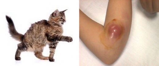 Kedi Tırmığı Hastalığı