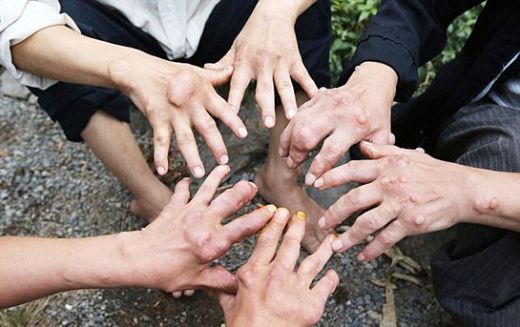 Kore Hastalığı Belirtileri ve Tedavisi