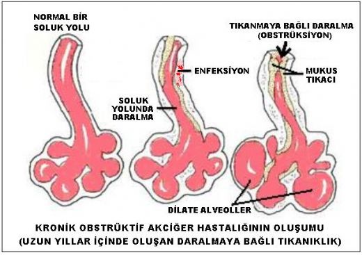 Kronik Obstrüktif Akciğer Hastalığı Belirtileri ve Tedavisi