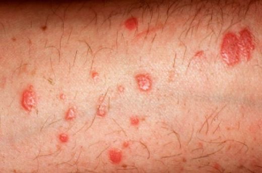 Liken Hastalığı Belirtileri ve Tedavisi