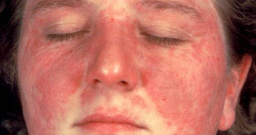 Lupus Hastalığı Belirtileri ve Tedavisi