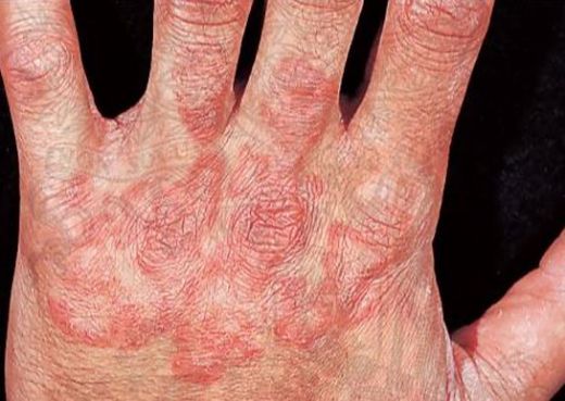 Mantar Hastalığı Belirtileri ve Tedavisi