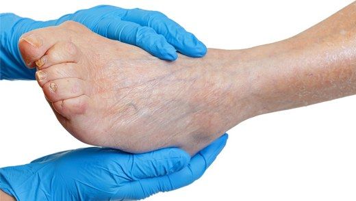 Periferik Arter Hastalığı Belirtileri ve Tedavisi