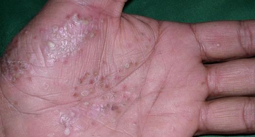 Peynir Hastalığı Belirtileri ve Tedavisi