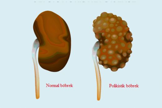 Polikistik Bbrek Hastal