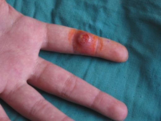 Şarbon Hastalığı Belirtileri ve Tedavisi