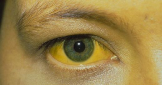 Sarılık Hastalığı Belirtileri ve Tedavisi