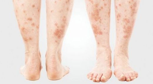 Sedef Hastalığı Bulaşıcı mı?