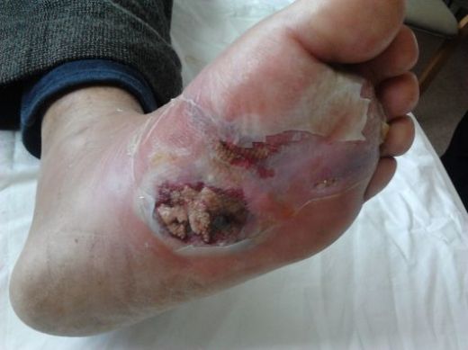 Şeker Hastalığı Yaraları Belirtileri ve Tedavisi