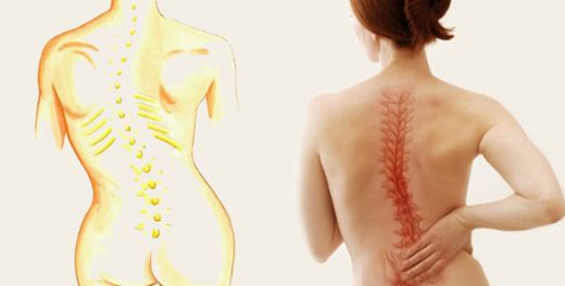 Skolyoz Hastalığı Belirtileri ve Tedavisi