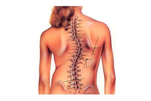 Skolyoz Hastalığı Nedir? Belirtileri ve Tedavisi