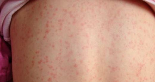 Still Hastalığı Belirtileri ve Tedavisi