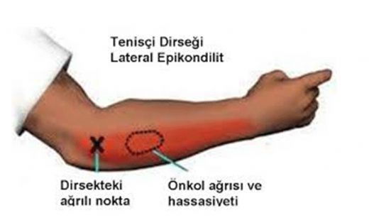 Tenisi Dirsei Hastal