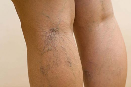 Varis Hastalığı Belirtileri ve Tedavisi