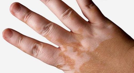 Vitiligo Hastalığı Belirtileri ve Tedavisi