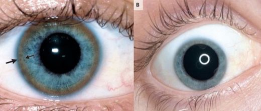 Wilson Hastalığı Belirtileri ve Tedavisi