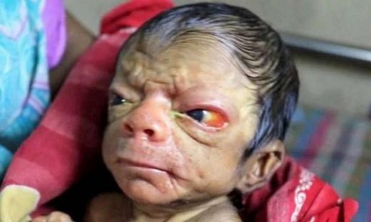 Yaşlanma Hastalığı Belirtileri ve Tedavisi