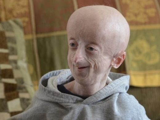 Yaşlılık Hastalığı Belirtileri ve Tedavisi