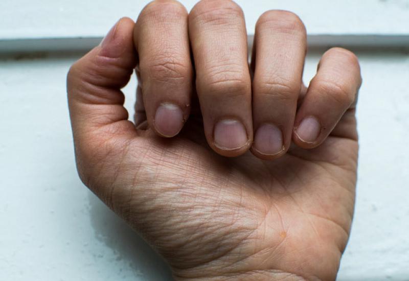 Beyaz Parmak Hastalığı Belirtileri ve Tedavisi